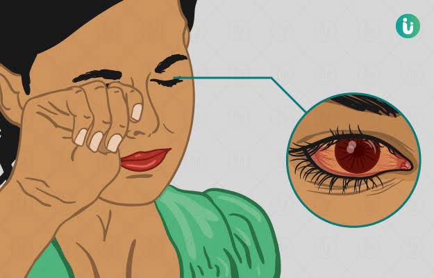 Allergic Conjunctivitis: Causes, Symptoms, Prevention, and Treatment