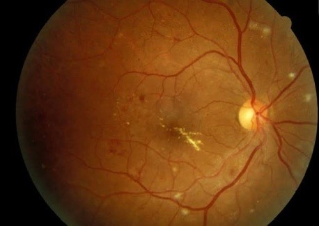 Diabetes and Eye Care